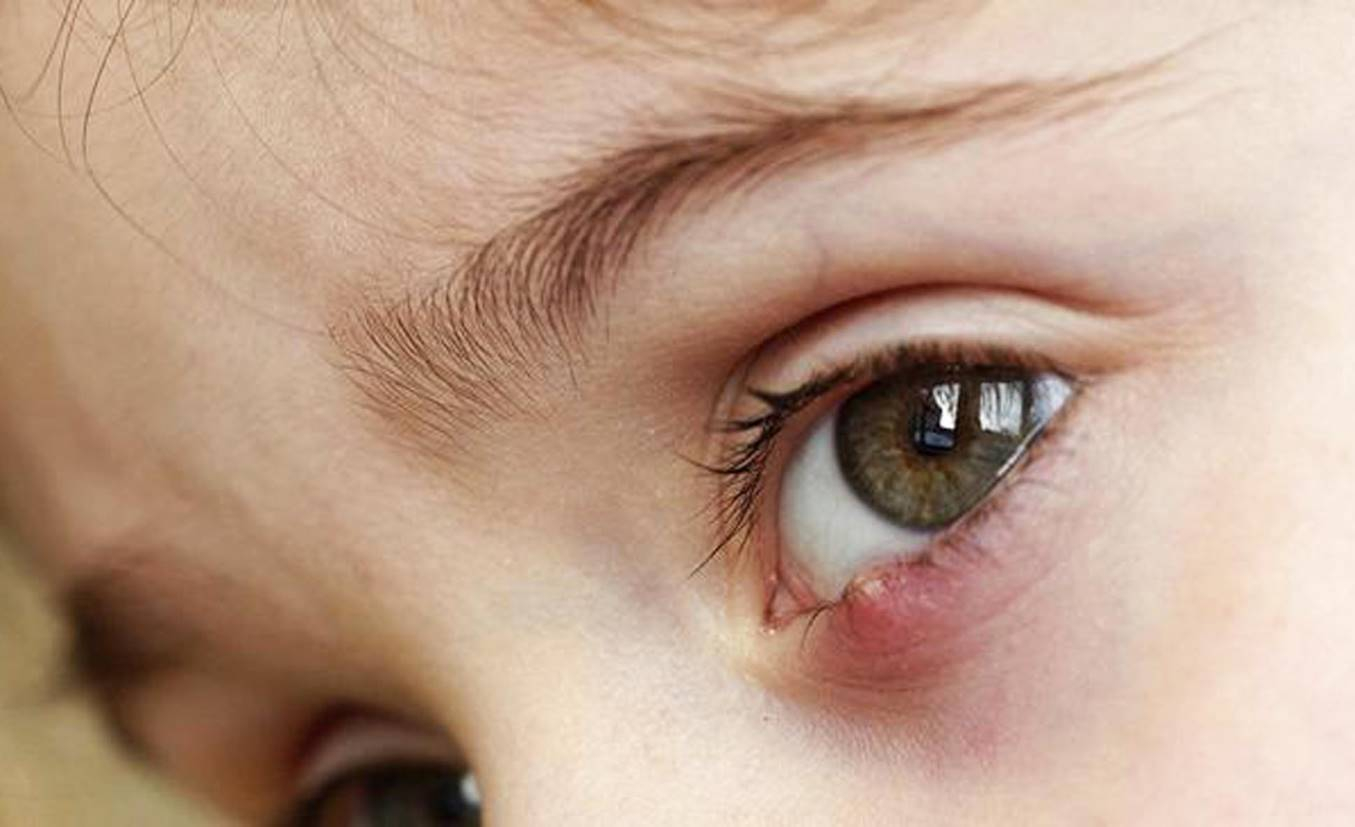 «Народный метод «плюнуть в глаз» забудьте навсегда»: как лечить ячмень у ребенка