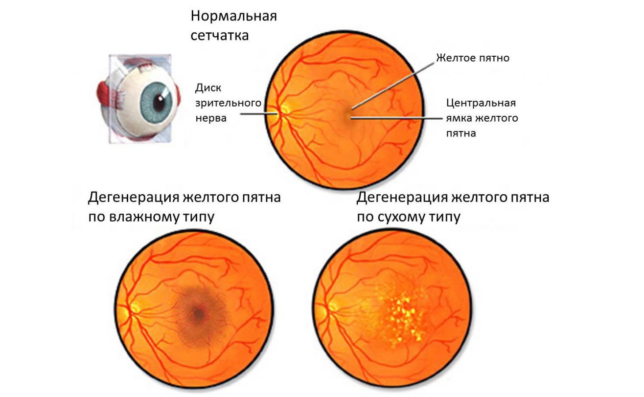 Паркетное глазное дно при миопии