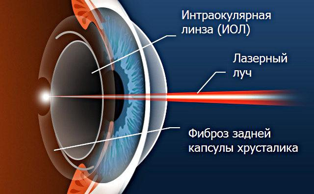 Лазерная Дисцизия Вторичной Катаракты Цена