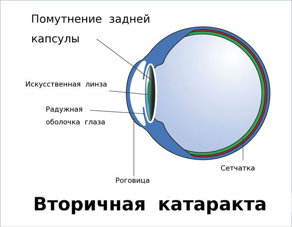 Вторичная катаракта после замены хрусталика