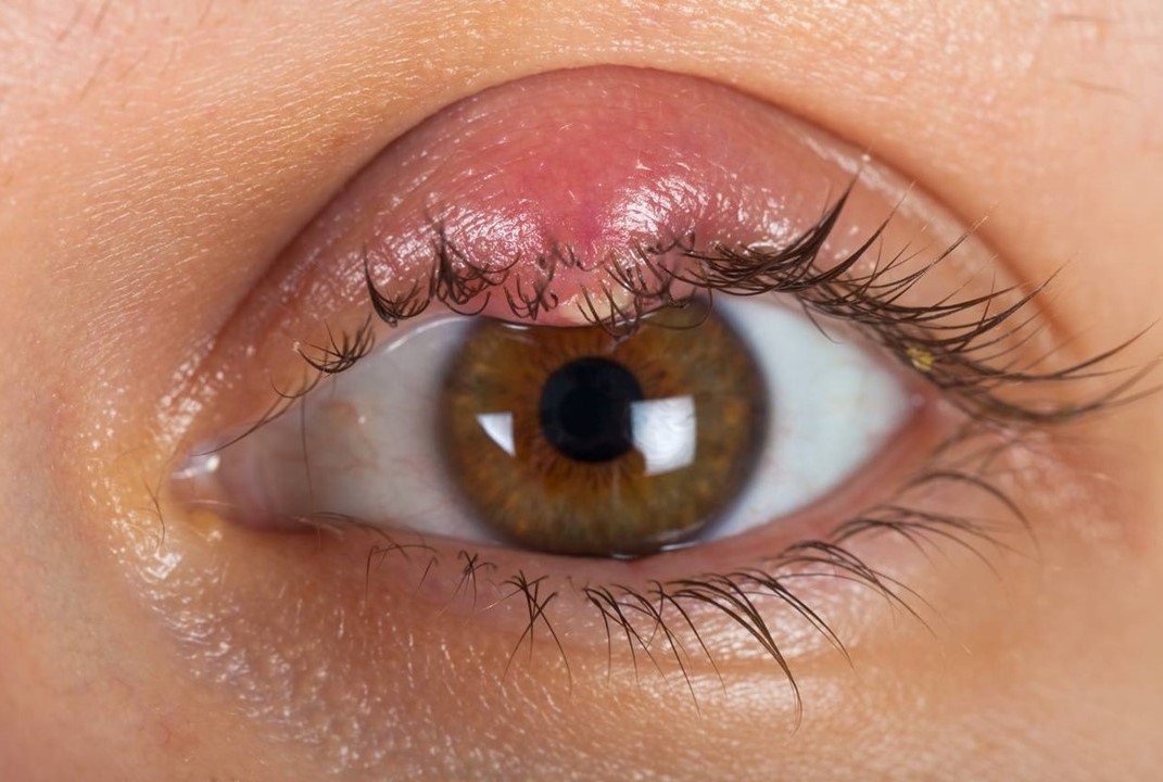 Инфекционные заболевания глаз